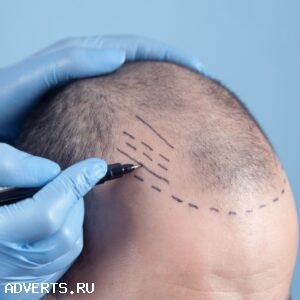 Пересадка волос для мужчин и женщин