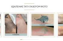 Безболезненное удаление татуировок лазером от 1000 рублей
